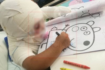 Finalmente, Gaia deberá operarse tras el accidente que le provocó quemaduras en más del 25% de su cuerpo