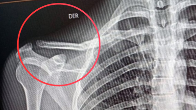 Se accident&oacute; en Pilar, sufri&oacute; una seria lesi&oacute;n y necesita ayuda para una operaci&oacute;n en el Vicente L&oacute;pez