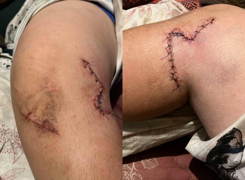 Un chico de 15 años chocó en moto en barrio Bicentenario y su madre pide ayuda para su tratamiento médico