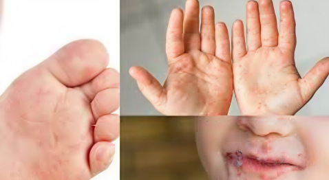 De qué se trata el virus de "manos, pies y boca" que afecta a los niños y qué repercusión hay a nivel local