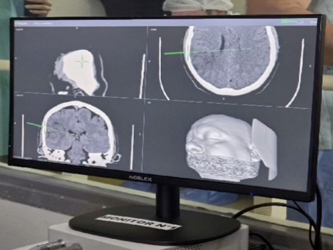 En el Hospital Vicente López se llevó a cabo una operación histórica de nivel internacional