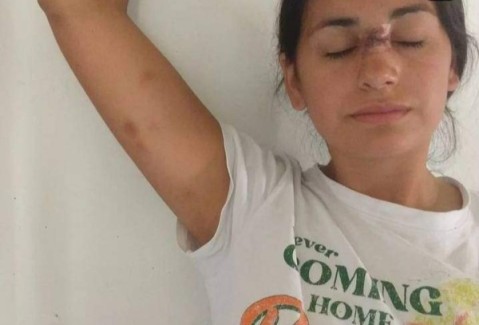 El drama de una joven que fue desfigurada por su novio policía: "Mirá a lo que llegamos"